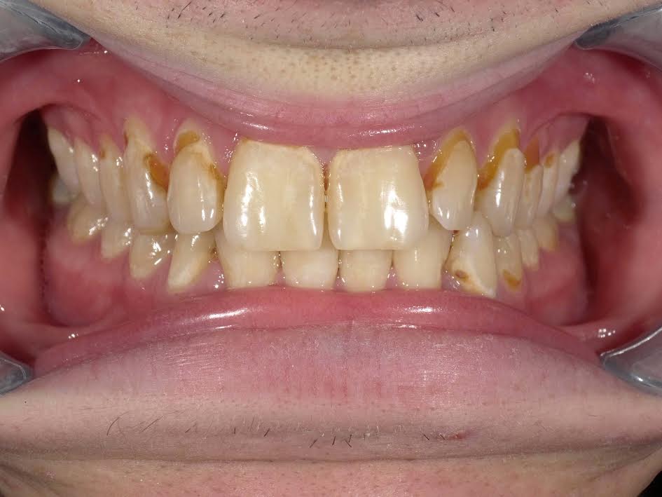 Amalgam-Free Fillings case 3 — before treatment