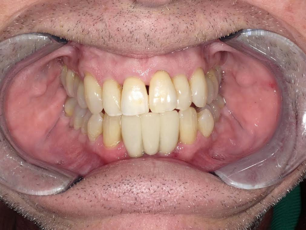 Dental Implants case — after treatment