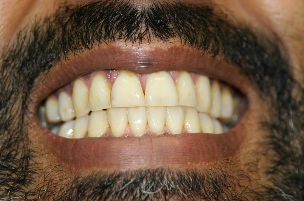 Teeth Whitening case 1 — before treatment