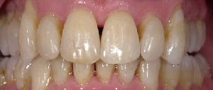 Teeth Straightening case 4 — after treatment