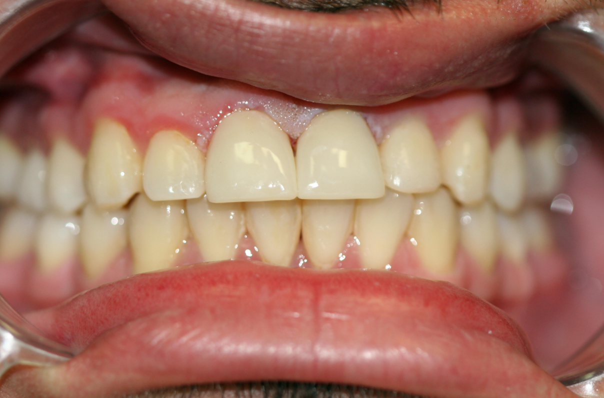 Crowns and Bridges case 1 — after treatment