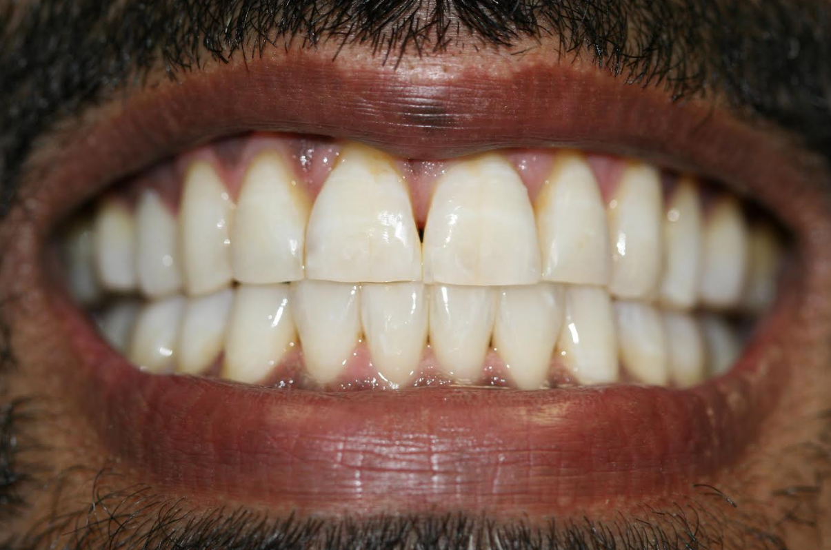 Teeth Whitening case 1 — after treatment