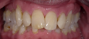 Teeth Straightening case 4 — before treatment