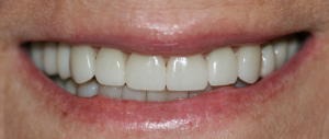 Veneers case 2 — after treatment