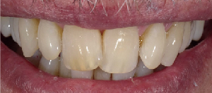Teeth Straightening case 3 — before treatment
