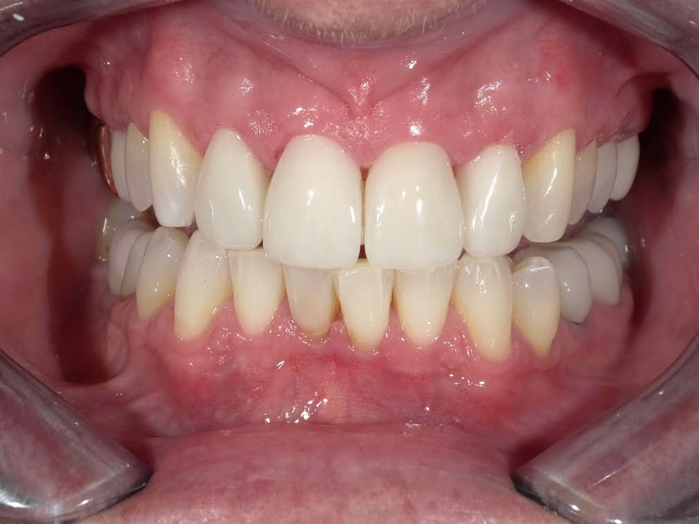 Veneers case 4 — after treatment