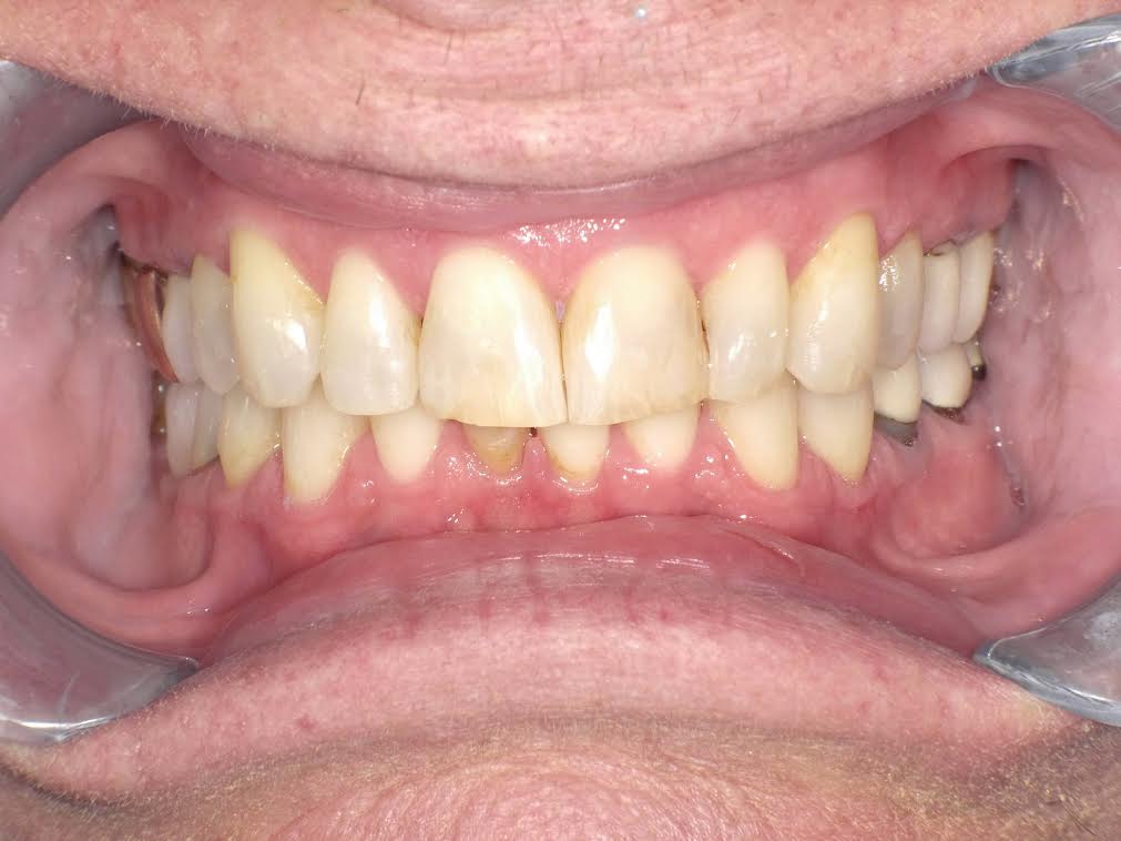 Veneers case 4 — before treatment