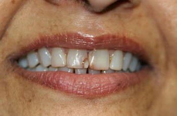 Amalgam-Free Fillings case 2 — before treatment