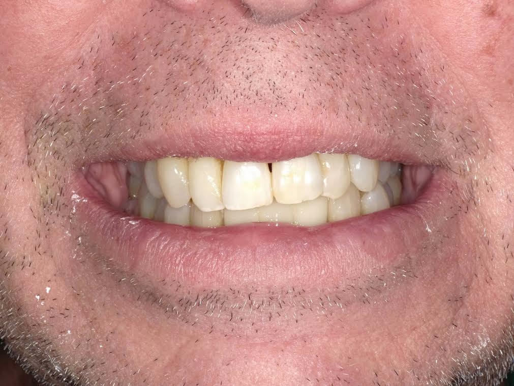 Dental Implants case — after treatment