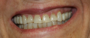 Veneers case 2 — before treatment