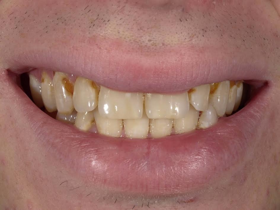 Amalgam-Free Fillings case 4 — before treatment