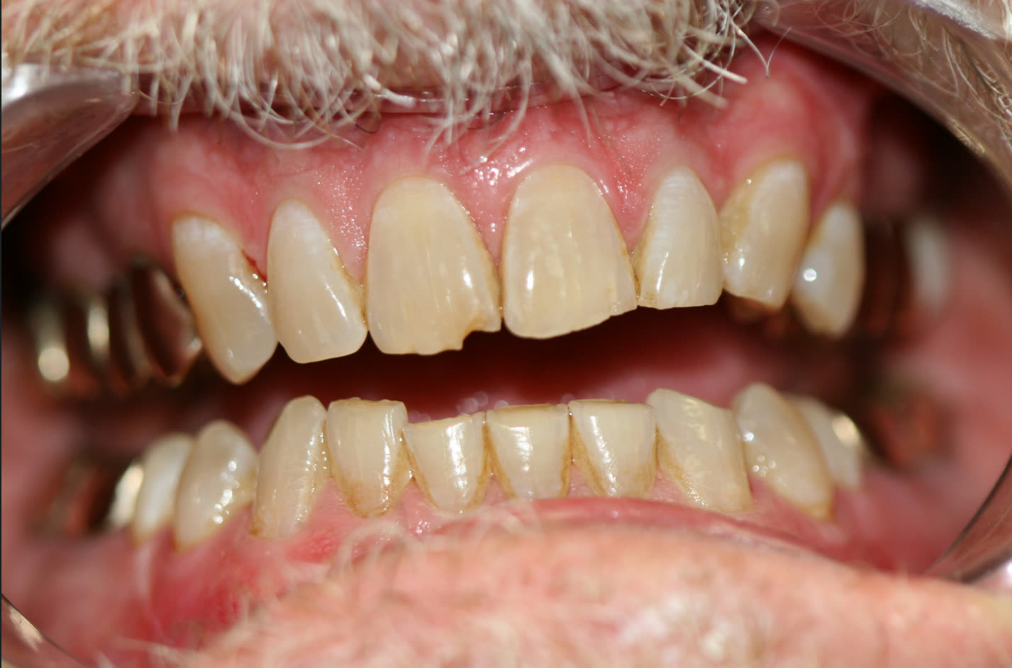 Amalgam-Free Fillings case 6 — before treatment