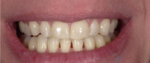 Teeth Straightening case 2 — after treatment