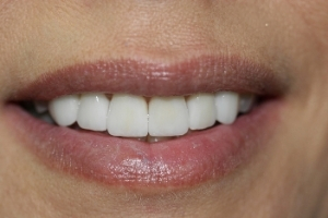 Veneers case 3 — after treatment