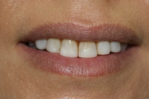 Veneers case 3 — before treatment
