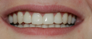 Veneers case 1 — after treatment