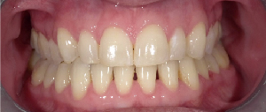 Teeth Straightening case 1 — after treatment