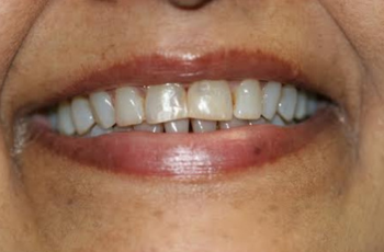 Amalgam-Free Fillings case 2 — after treatment