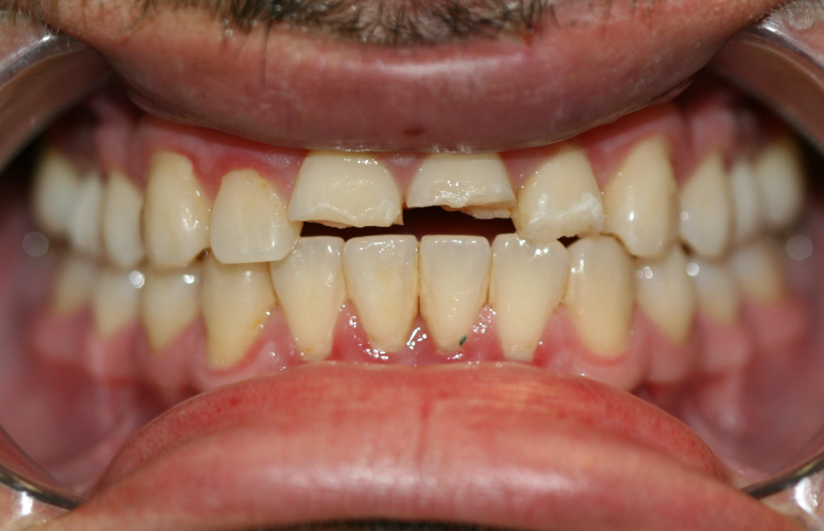 Amalgam-Free Fillings case 5 — before treatment