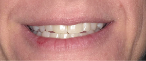 Teeth Straightening case 2 — before treatment