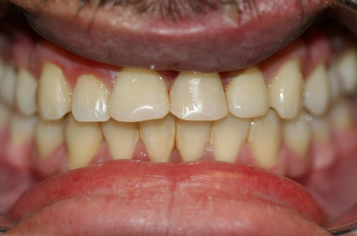 Amalgam-Free Fillings case 5 — after treatment