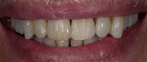 Teeth Straightening case 3 — after treatment