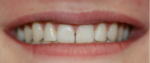 Veneers case 1 — before treatment