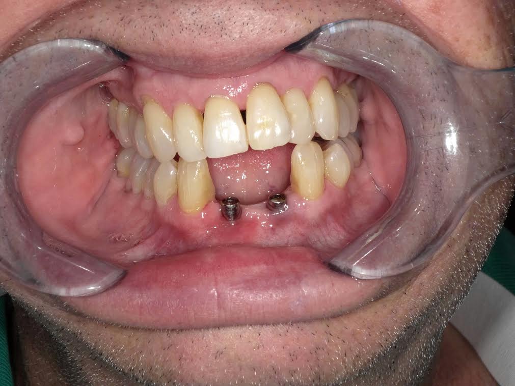 Dental Implants case — before treatment