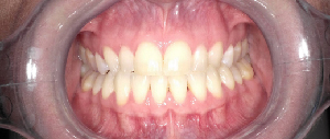 Teeth Straightening case 1 — before treatment