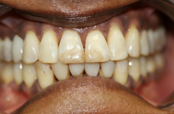 Amalgam-Free Fillings case 1 — before treatment
