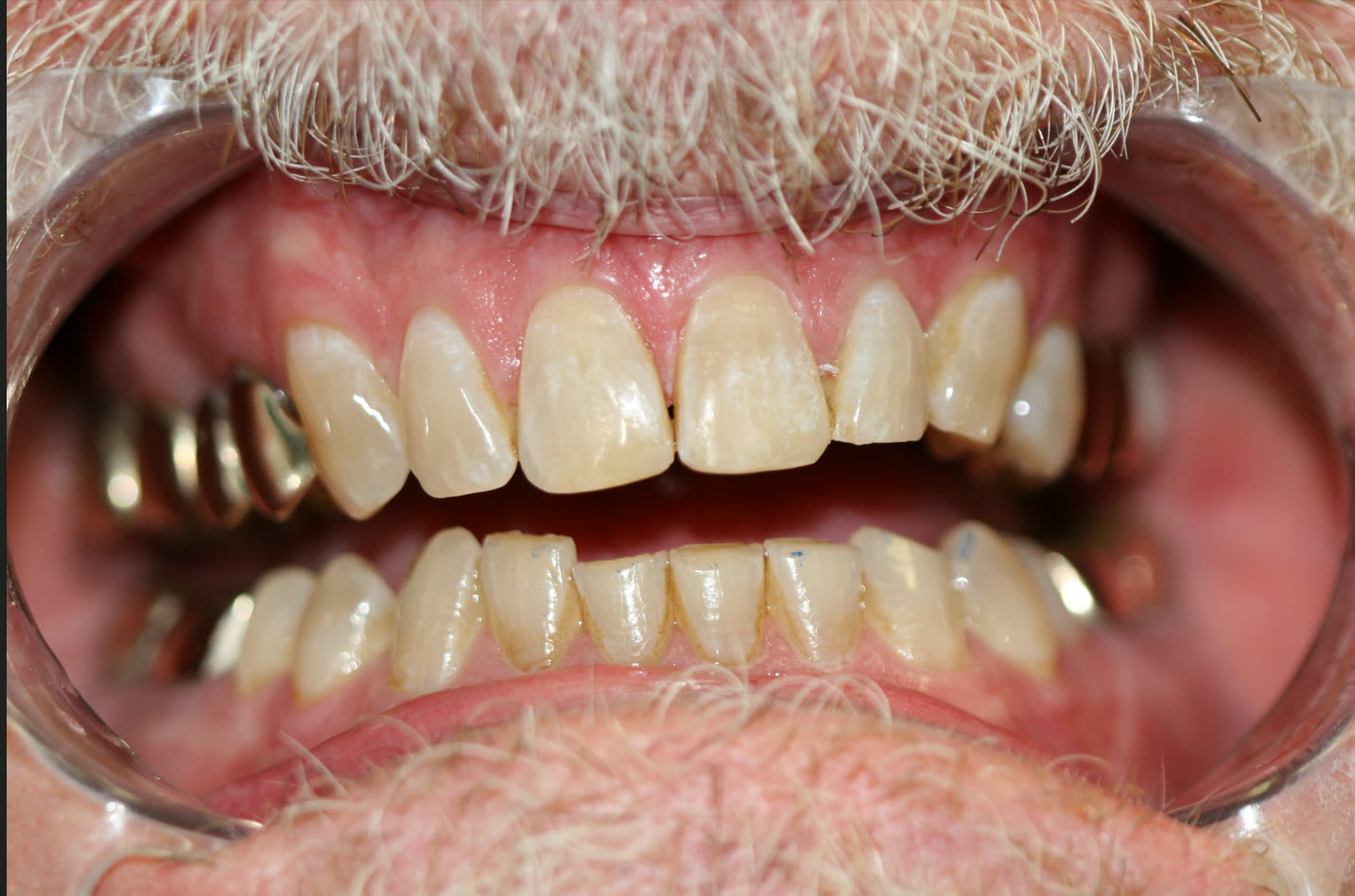 Amalgam-Free Fillings case 6 — after treatment