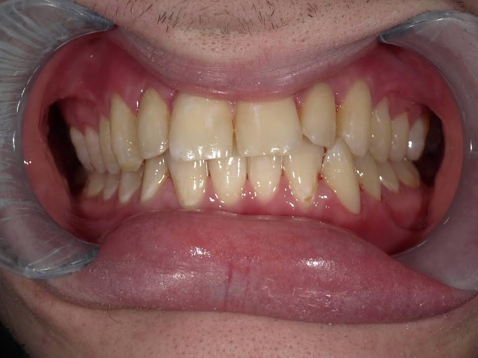 Amalgam-Free Fillings case 3 — after treatment
