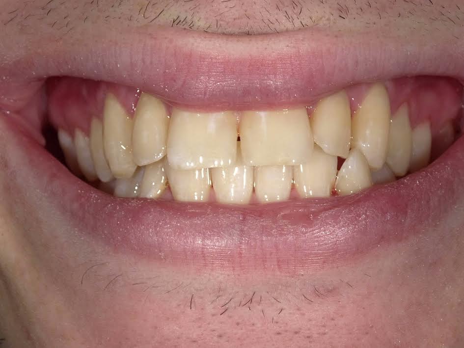 Amalgam-Free Fillings case 4 — after treatment