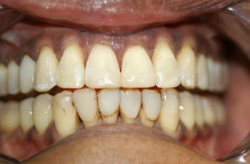 Amalgam-Free Fillings case 1 — after treatment